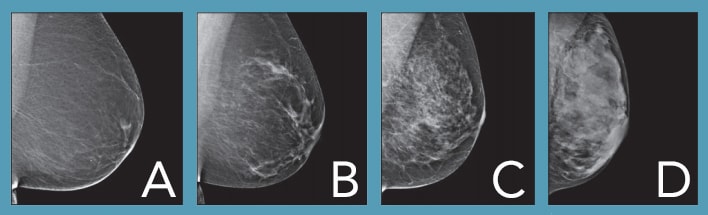 The image shows four categories of breast density used in mammography to classify the amount of fibrous or glandular tissue in the breasts compared to fatty tissue.